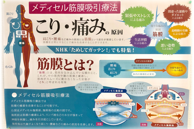 メディセル筋膜吸引療法