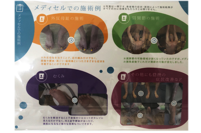 メディセル筋膜吸引療法